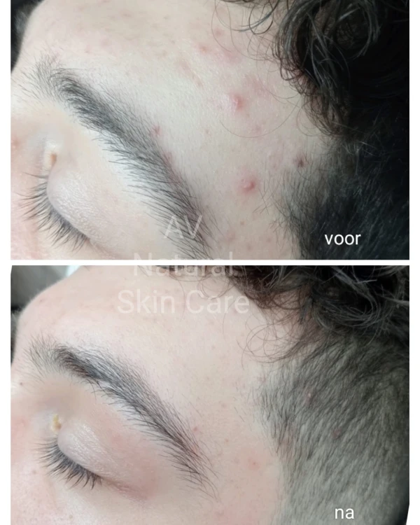 ACNE BEHANDELING