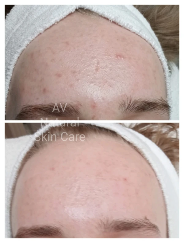 NATUURLIJKE ACNE BEHANDELING